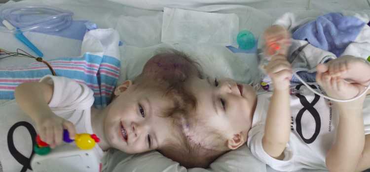 頭蓋骨結合 脳がつながった状態で生まれた13か月の双子の分離手術が成功 ニュースパス